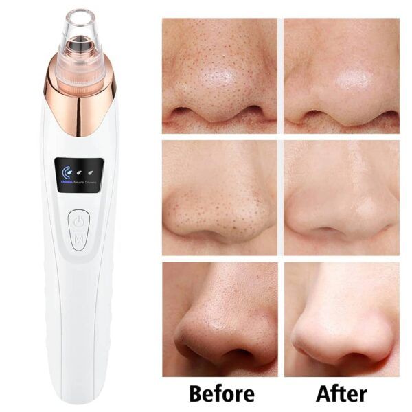 5 in 1 Blackhead remover | Derma Suction  | Rechargeable | Free Gift Card 🎁